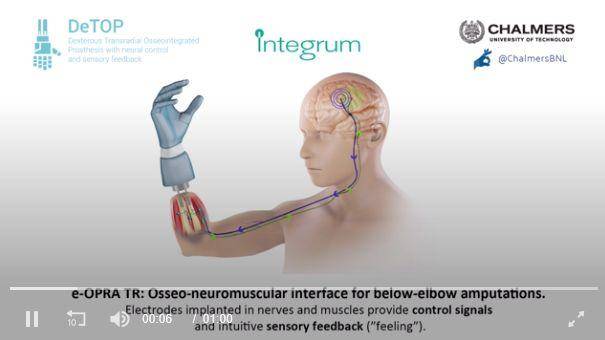 全球第一個靈巧且有感覺的假手已經(jīng)成功植入-肽度TIMEDOO