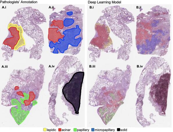 肺癌診斷新突破！機器學(xué)習(xí)識別腫瘤模式及亞型，表現(xiàn)與病理學(xué)家相當(dāng)-肽度TIMEDOO