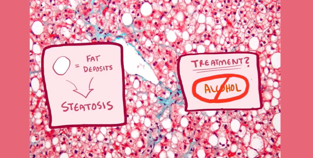 醫(yī)學(xué)動畫:為什么說長期攝入酒精是導(dǎo)致肝病和肝硬化的最主要的原因-肽度TIMEDOO