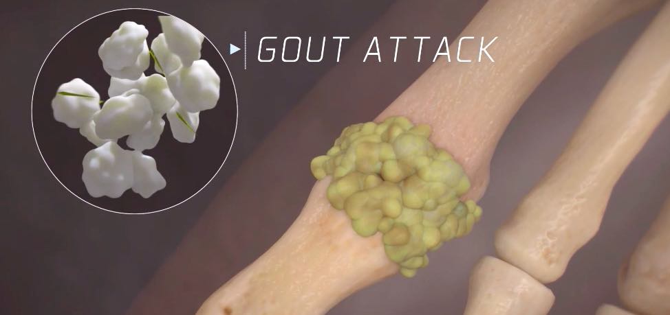 醫(yī)學(xué)動(dòng)畫(huà): 為什么痛風(fēng)通常發(fā)生在一個(gè)關(guān)節(jié)上呢？-肽度TIMEDOO