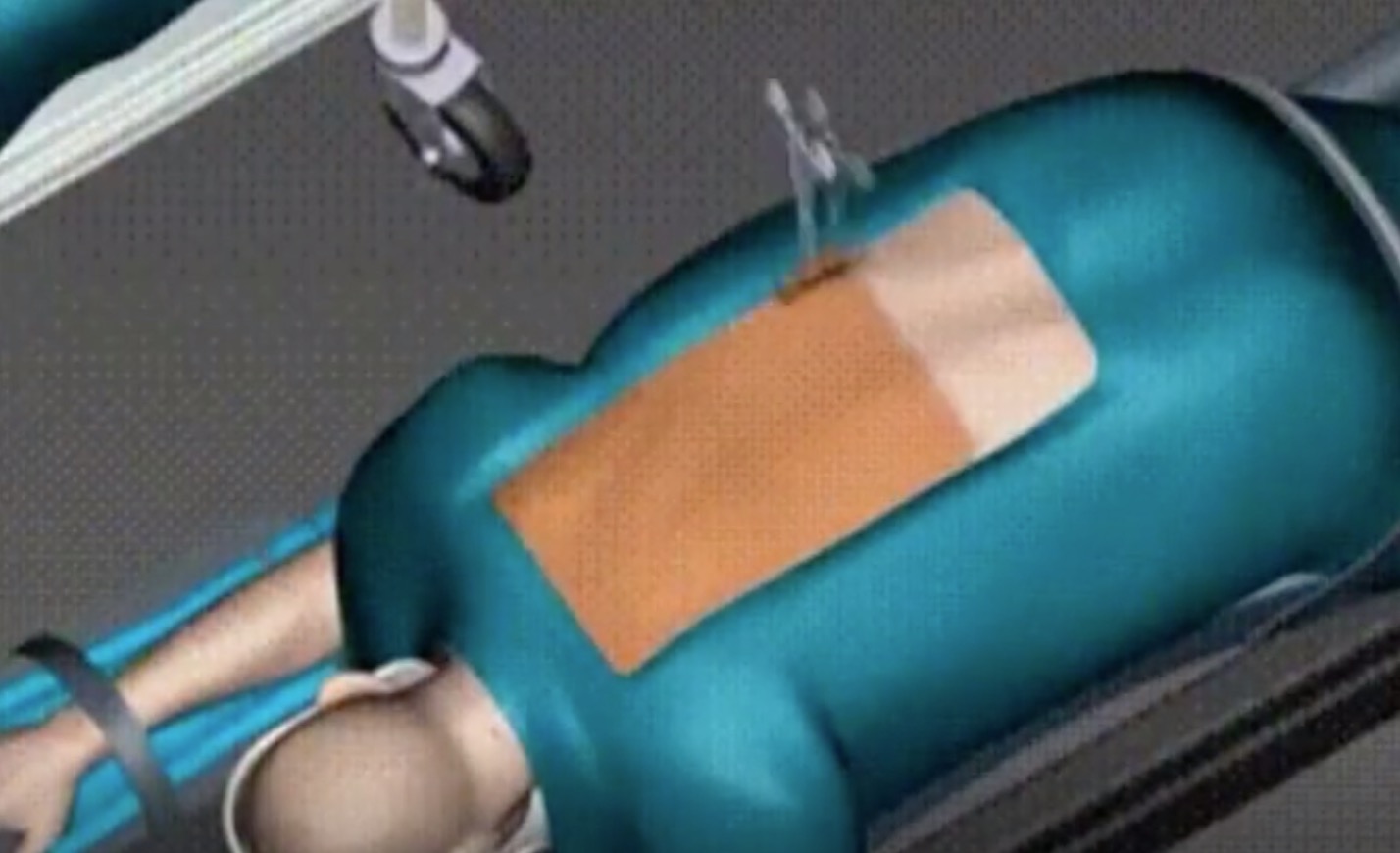 3D醫(yī)學(xué)動(dòng)畫|演示脊柱側(cè)彎糾正手術(shù)-肽度TIMEDOO