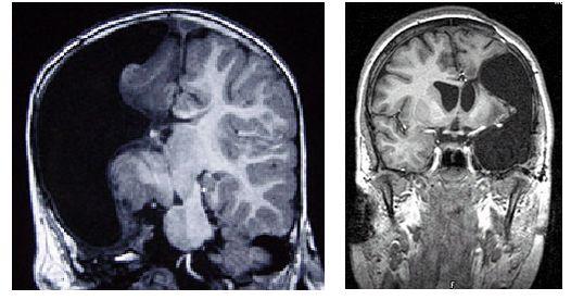 只剩一半大腦會(huì)怎樣？6個(gè)罕見(jiàn)病例首次揭示：半個(gè)大腦也能“全職”工作-肽度TIMEDOO