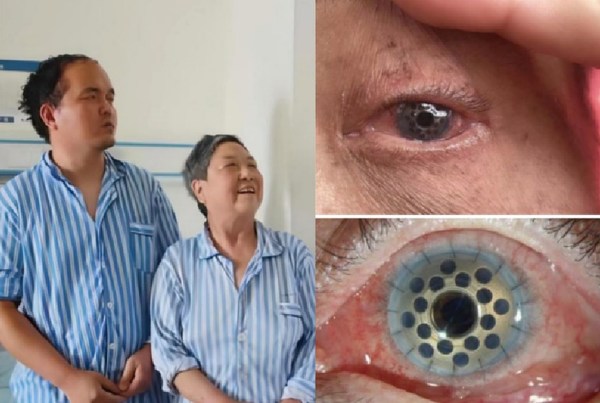 國(guó)產(chǎn)領(lǐng)扣型人工角膜手術(shù)在各重點(diǎn)醫(yī)院開(kāi)展，為角膜盲患者帶來(lái)希望-肽度TIMEDOO