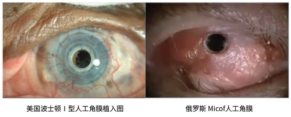 國(guó)產(chǎn)領(lǐng)扣型人工角膜手術(shù)在各重點(diǎn)醫(yī)院開(kāi)展，為角膜盲患者帶來(lái)希望-肽度TIMEDOO