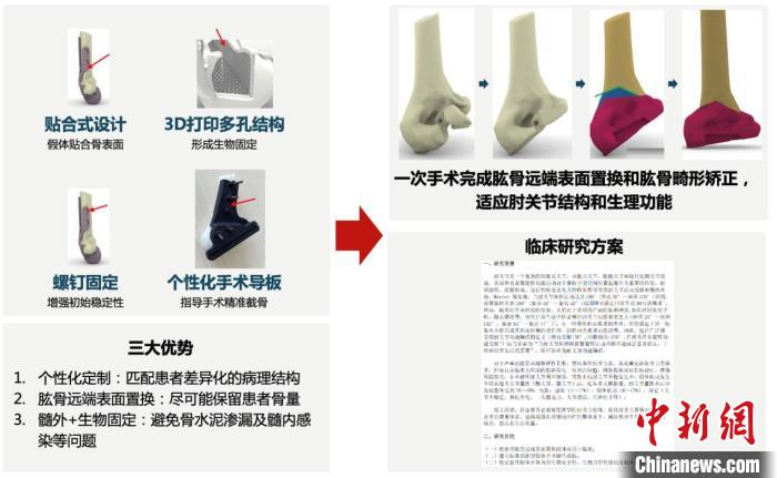 中國自主研發(fā)新型表面置換假體 填補空白、造福肘關(guān)節(jié)損傷者-肽度TIMEDOO