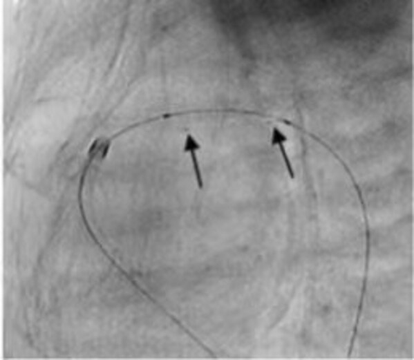 先健科技IBS Angel(TM)鐵基可吸收支架系統(tǒng)獲得歐盟CE MDR認(rèn)證-肽度TIMEDOO