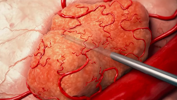 以色列Alpha TAU公司研發(fā)的針對(duì)實(shí)體瘤的創(chuàng)新阿爾法放射治療取得顯著成果-肽度TIMEDOO