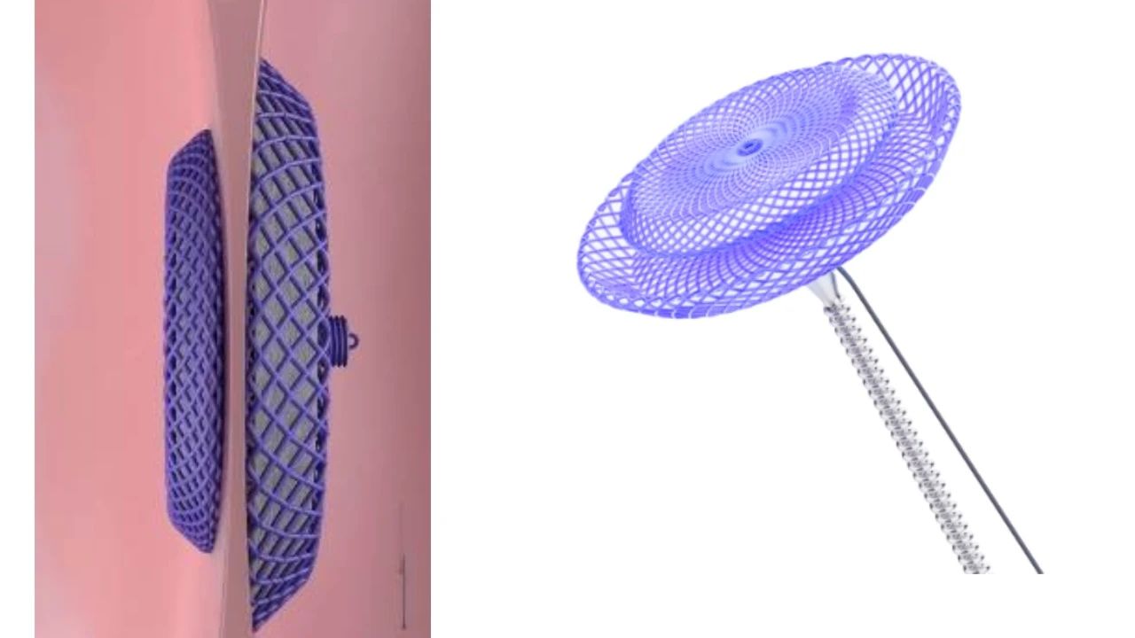 全球首個,四川大學研發(fā)心源性卒中可降解封堵器-肽度TIMEDOO