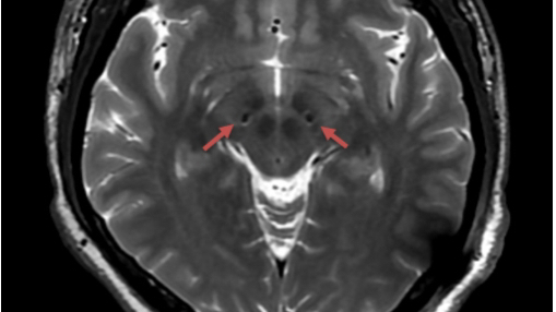 40歲患上帕金森，核磁共振還能做嗎？仁濟團隊為患者植入最新國產(chǎn)腦起搏器-肽度TIMEDOO