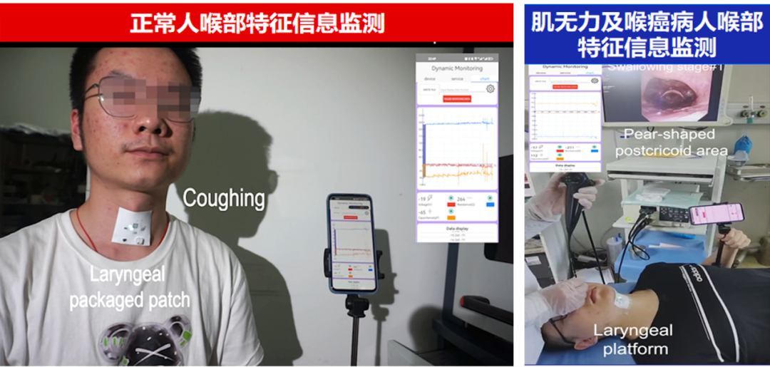 不做喉鏡也能監(jiān)測喉部康復(fù)-肽度TIMEDOO