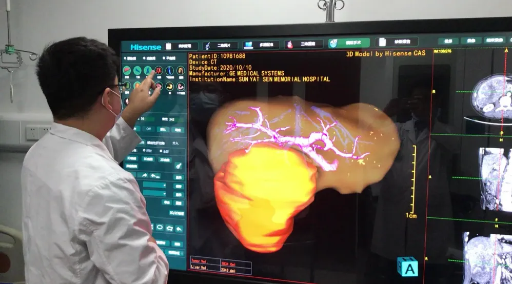 2024版肝癌指南新視角:商昌珍教授深度解讀外科治療-肽度TIMEDOO