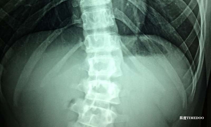 匹茲堡大學(xué)研究開創(chuàng)新療法，為脊髓性肌萎縮癥患者帶來希望-肽度TIMEDOO