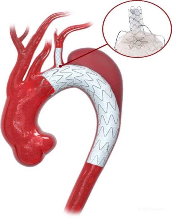 NMPA獲批！全球首創(chuàng)！先健主動脈原位開窗分支重建創(chuàng)新產(chǎn)品矩陣上市-肽度TIMEDOO