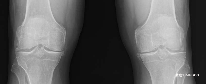 重大發(fā)現(xiàn)！GWAS首次揭示兩種基因?qū)е骡}焦磷酸鹽沉積?。–PPD）-肽度TIMEDOO